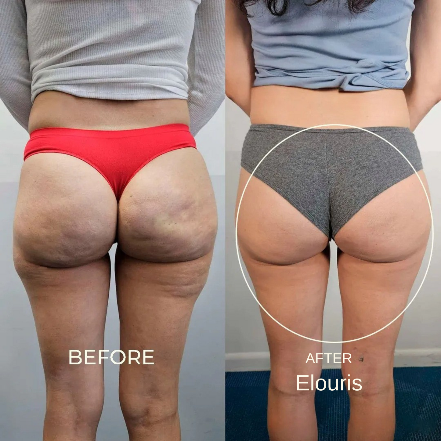 Firm and Tone Tool | Cellulite Relief Kit