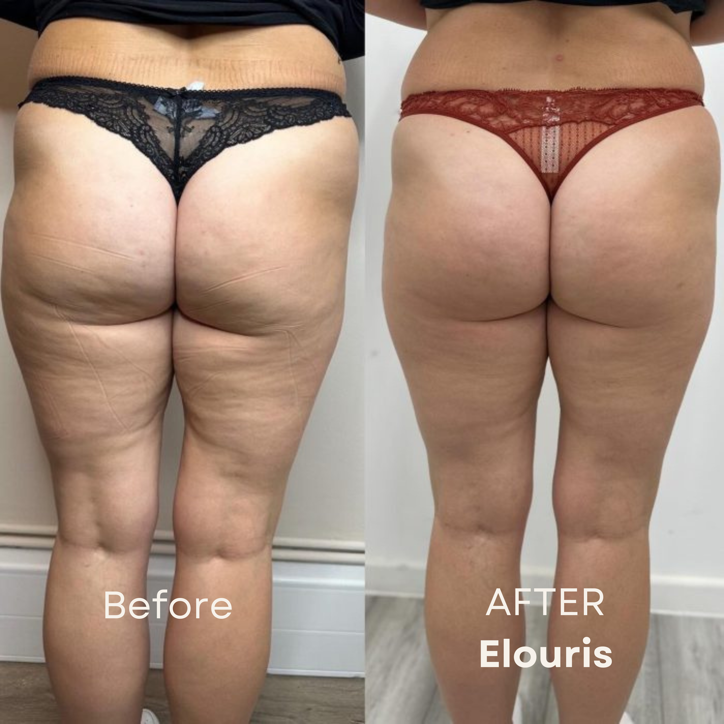 Firm and Tone Tool | Cellulite Relief Kit