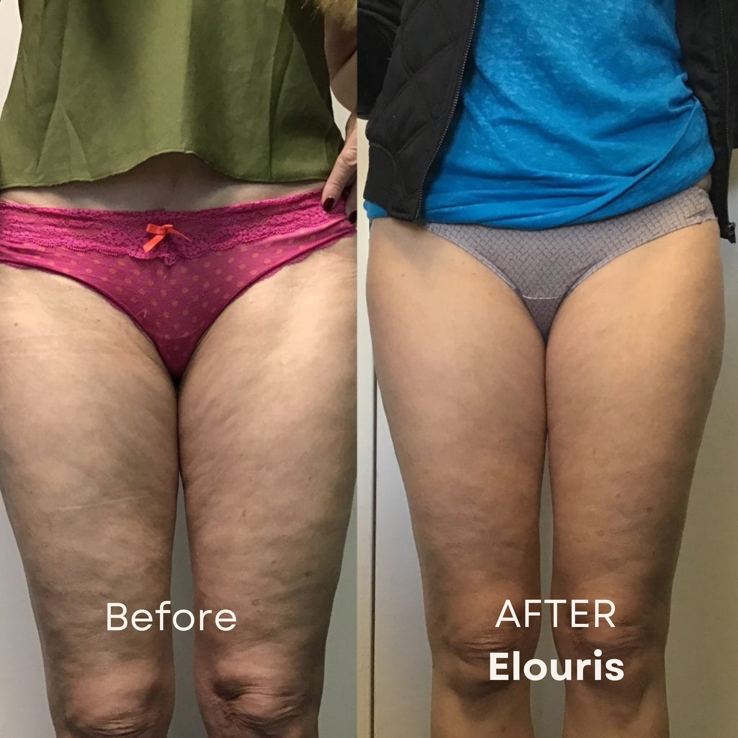 Firm and Tone Tool | Cellulite Relief Kit