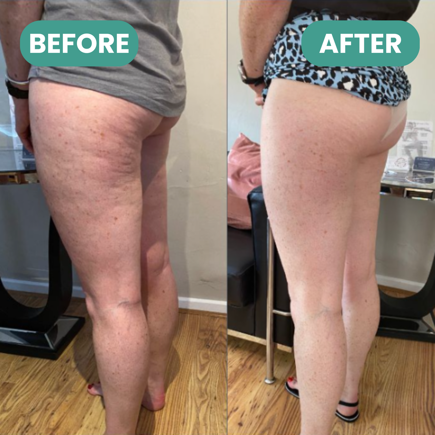 Anti-Cellulite | Firm & Tone Tool