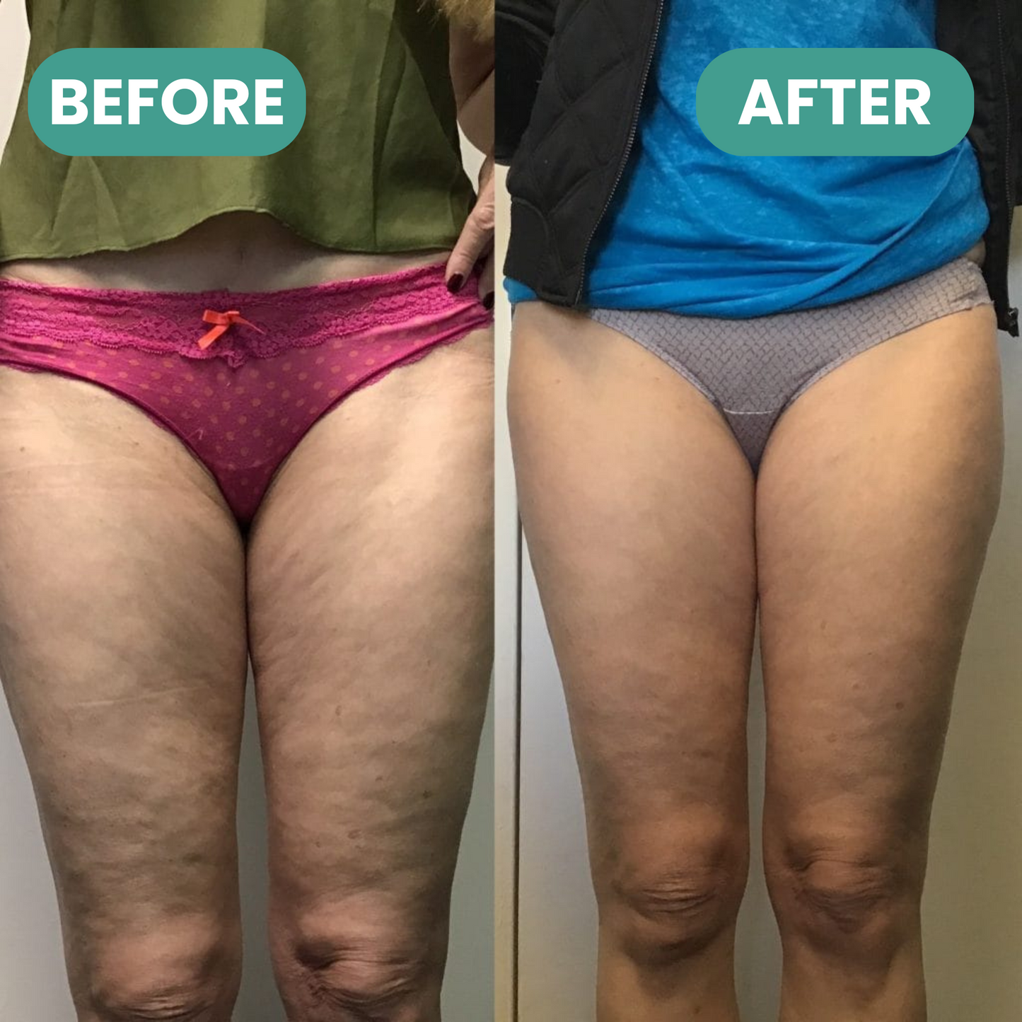 Anti-Cellulite | Firm & Tone Tool