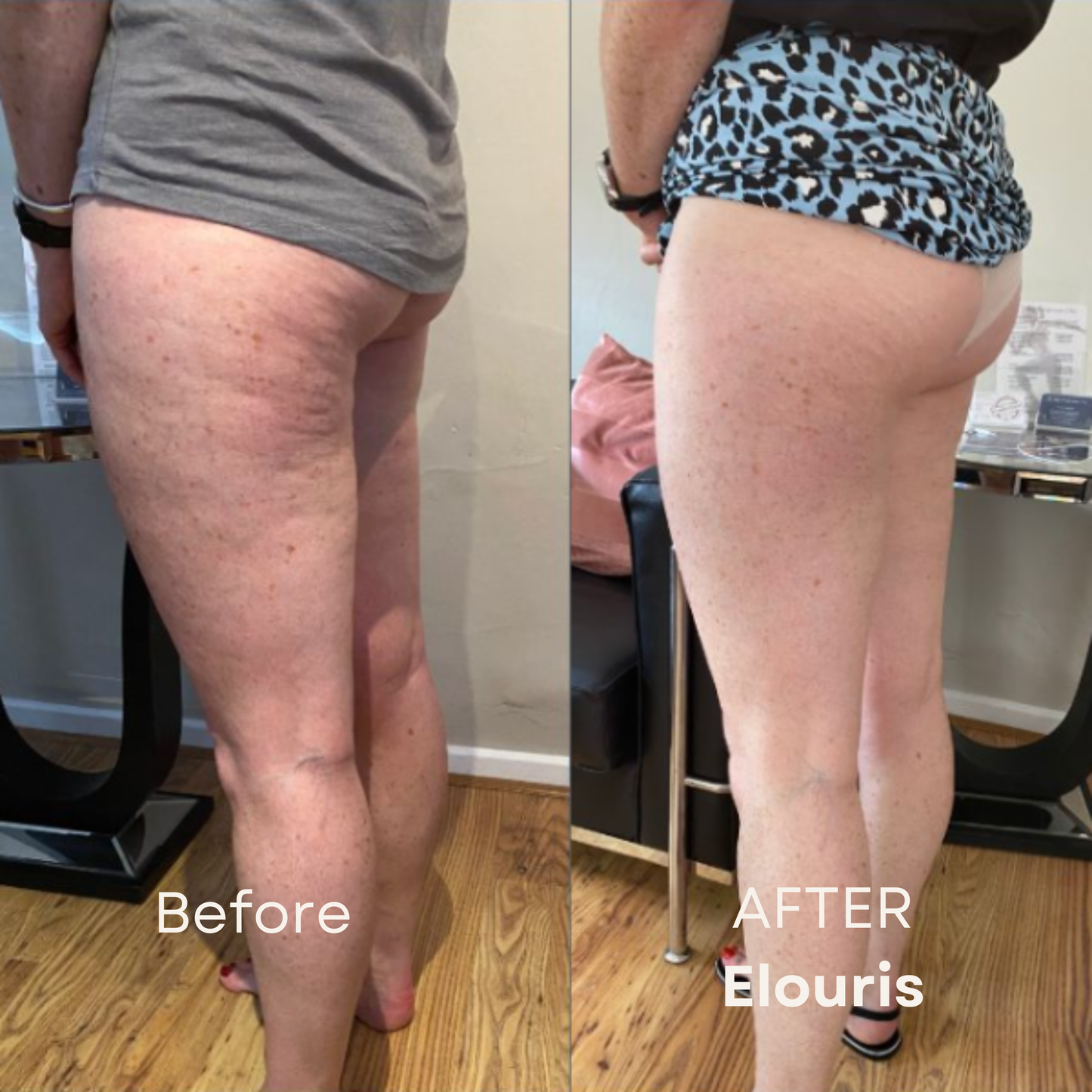 Firm and Tone Tool | Cellulite Relief Kit